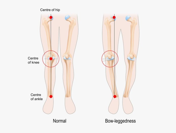 Living with knee pain in your 40s? What can you do now to prevent knee